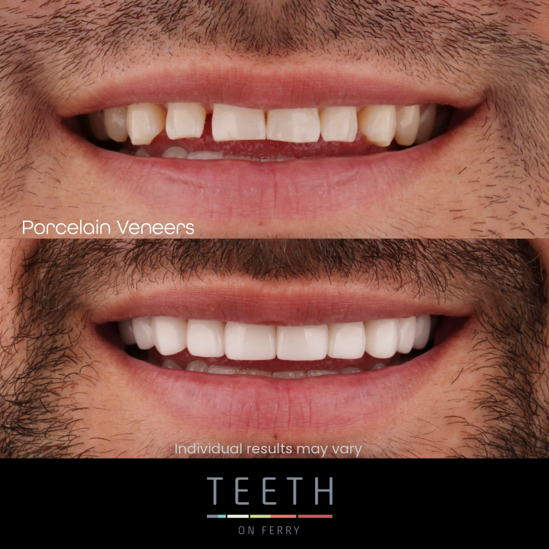 gold coast veneers veneers gold coast