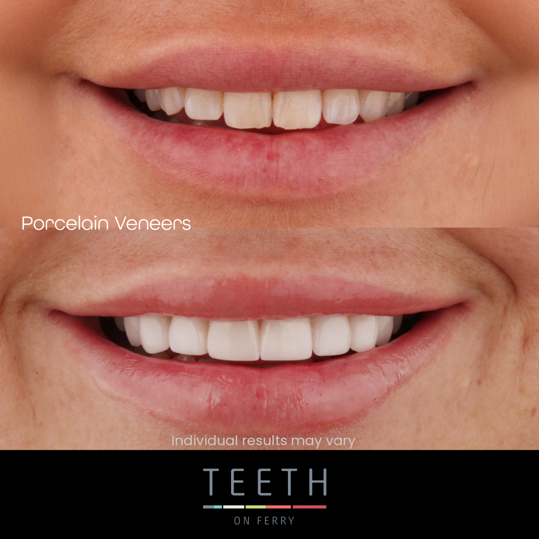 gold coast veneers veneers gold coast