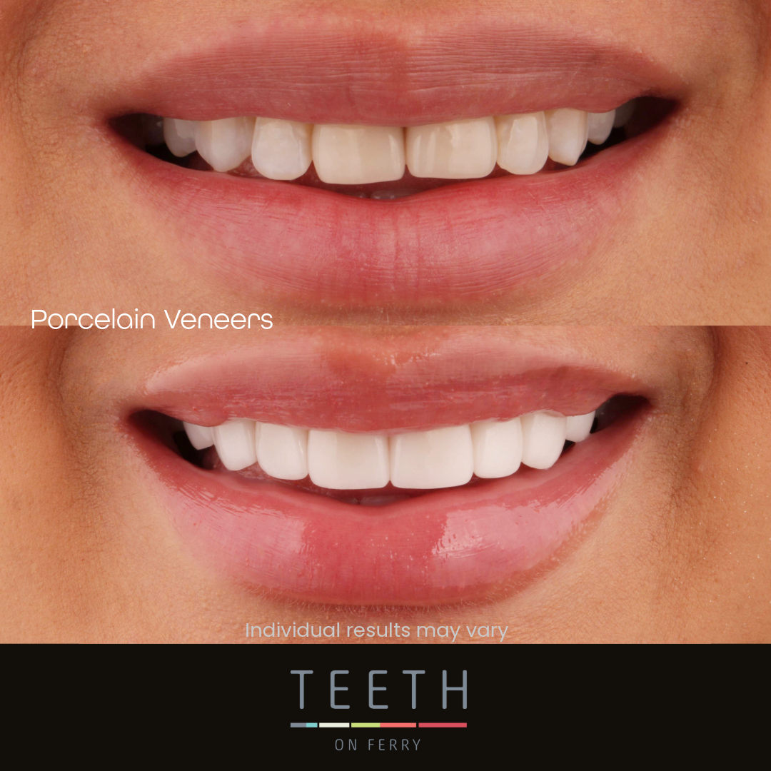 gold coast veneers veneers gold coast